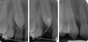 Radiografie: canino non erotto agganciato chirurgicamente e trazionato in arcata mediante terapia ortodontica