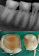 Rx di carie su molare e premolare e preparazione cavità