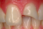 Foto di trauma con frattura del frammento incisale