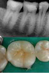 Ricostruzione indiretta del molare (intarsio) e diretta del premolare (resina composita)