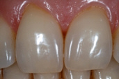 Foto di denti discolorati