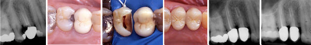 Foto di lesioni cariose penetranti e trattamento endodontico