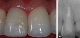 Foto del risultato del trattamento endodontico