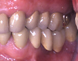 Dente molare, supporto di protesi, da estrarre in paziente con parodontite