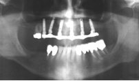 Radiografia del caso clinico al termine del lavoro implantare e protesico