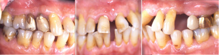 Tre foto di grave parodontite con gravi deficit funzionali ed estetici