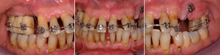 Tre foto di terapia ortodontica effettuata dopo terapia parodontale