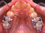 Foto trattamenti ortodontici in giovani pazienti