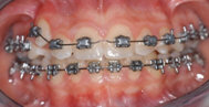 Foto trattamenti ortodontici in giovani pazienti