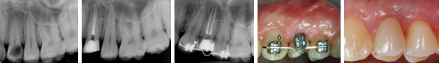 Radiografie e foto di dente con carie profonda, trattato endodicamente, estruso con ortodonzia