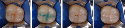 Foto sigillatura di un molare inferiore